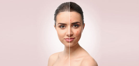 Clear & Glowing Skin with Acne Gel: Best Solution for Breakouts