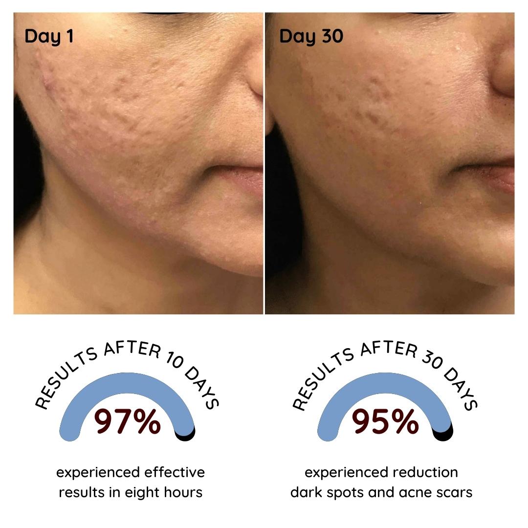 Buy 5% Benzoyal Peroxide Acne Gel - Suroskie