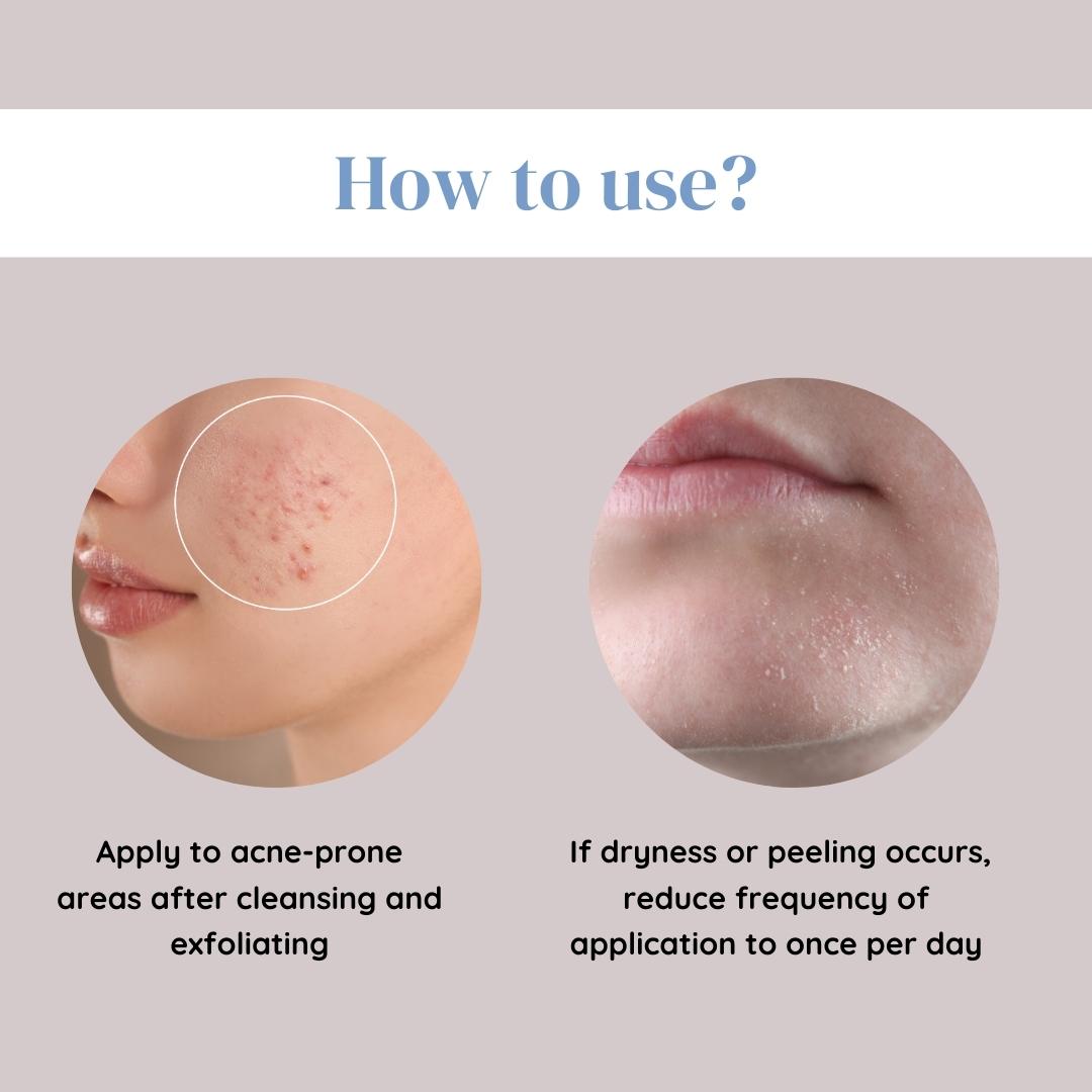 How to Use 5% Benzoyal Peroxide Acne Gel?