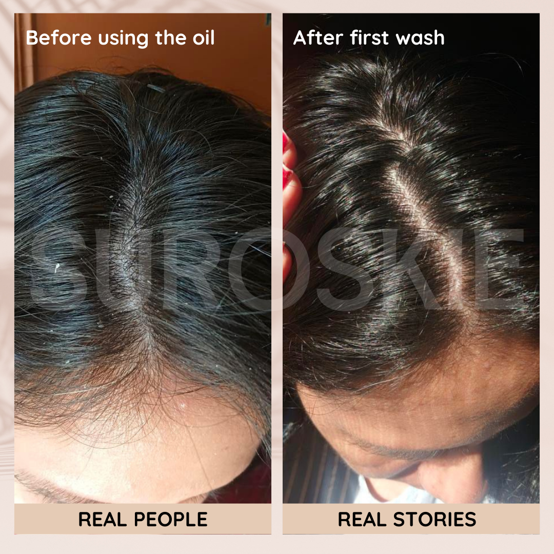 Anti-dandruff Scalp Treatment Hair Oil With Rosemary & Argan Oil